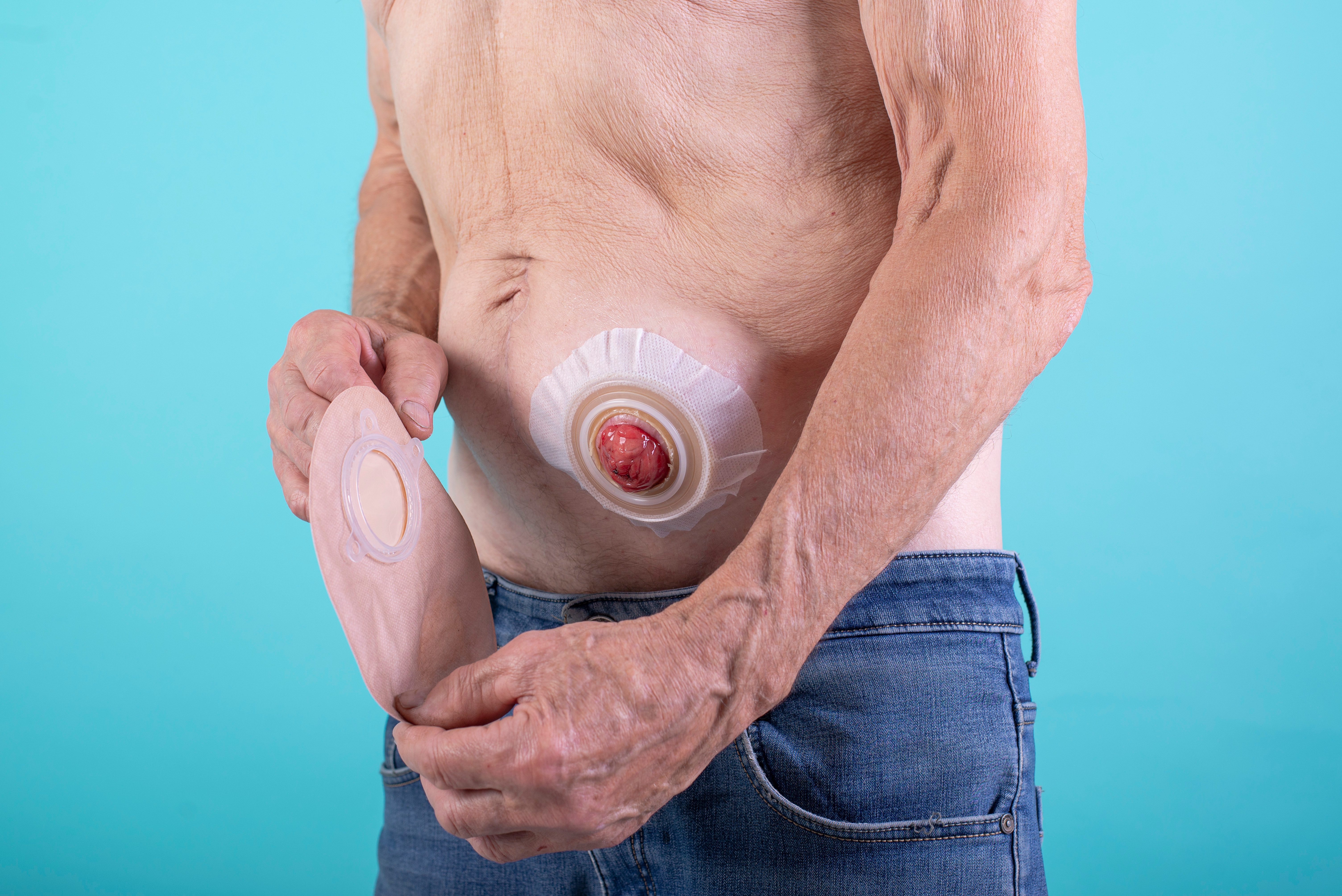 Stoma Care 