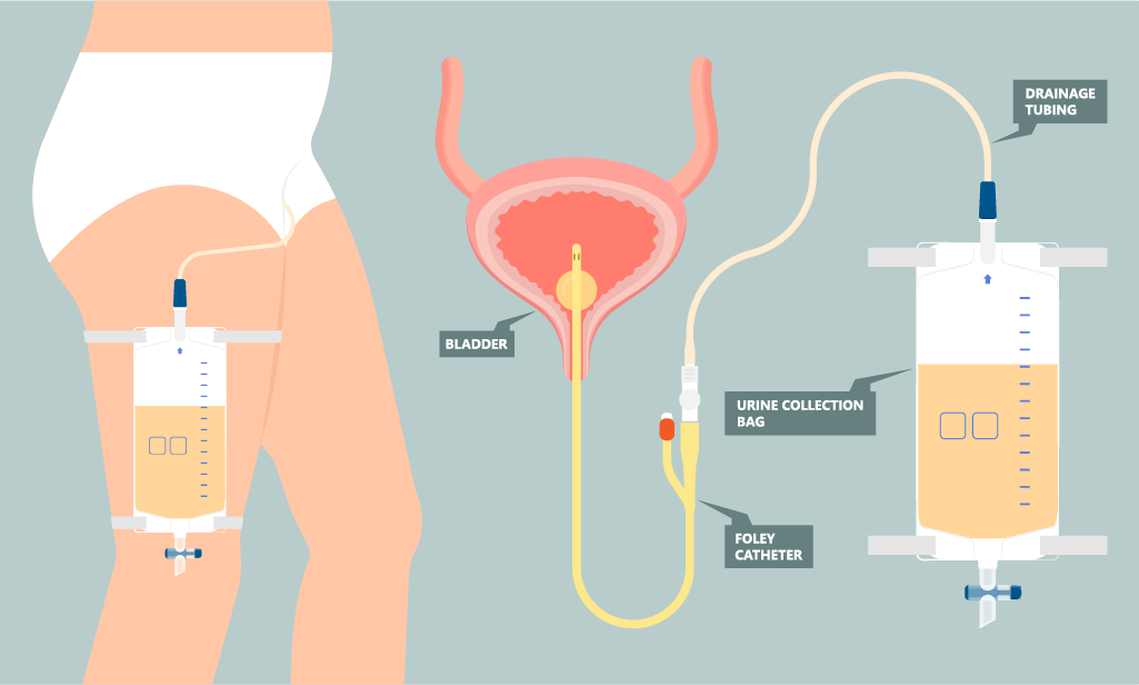 Catheterisation Training for Nurses and Carers