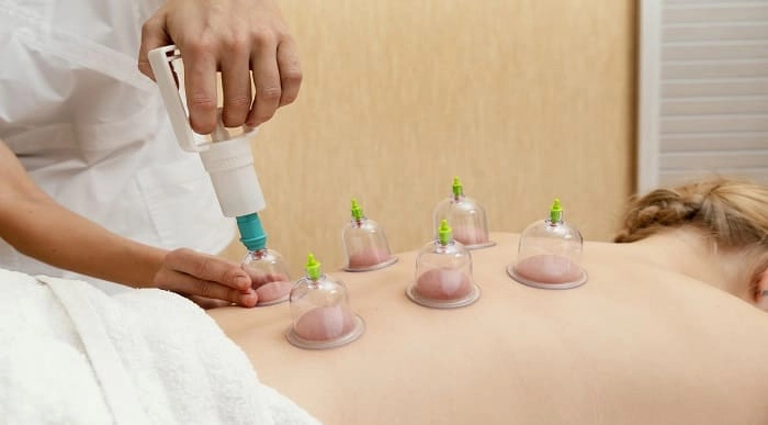 Cupping