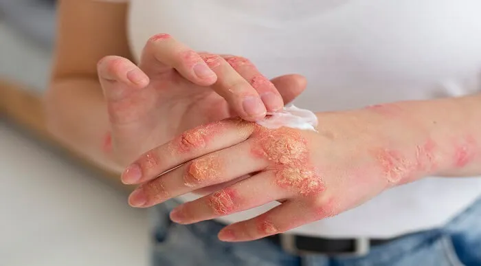 Eczema Solution