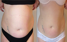 Combined Radio Frequency and Lipo-Cavitation Course