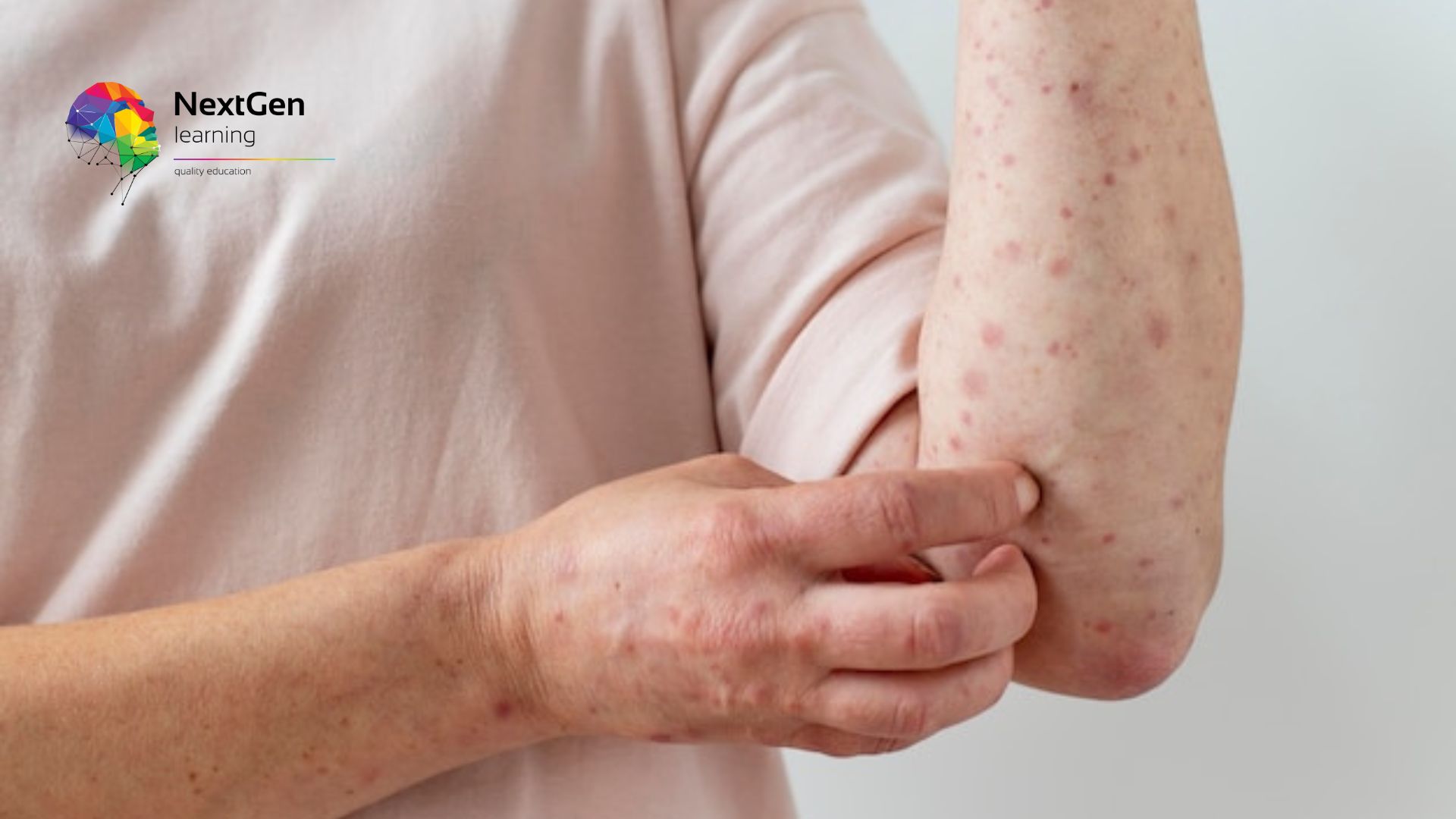 Monkeypox Awareness