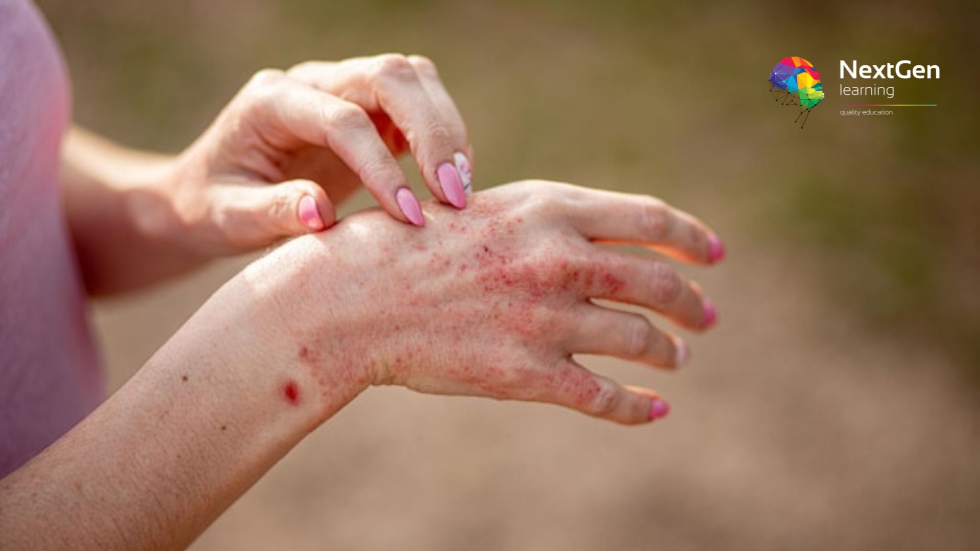 Curing Eczema