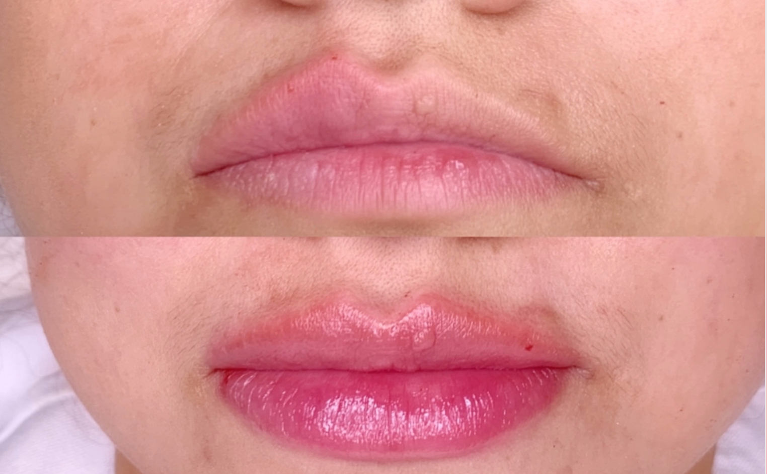 Advanced Lip Enhancement Masterclass