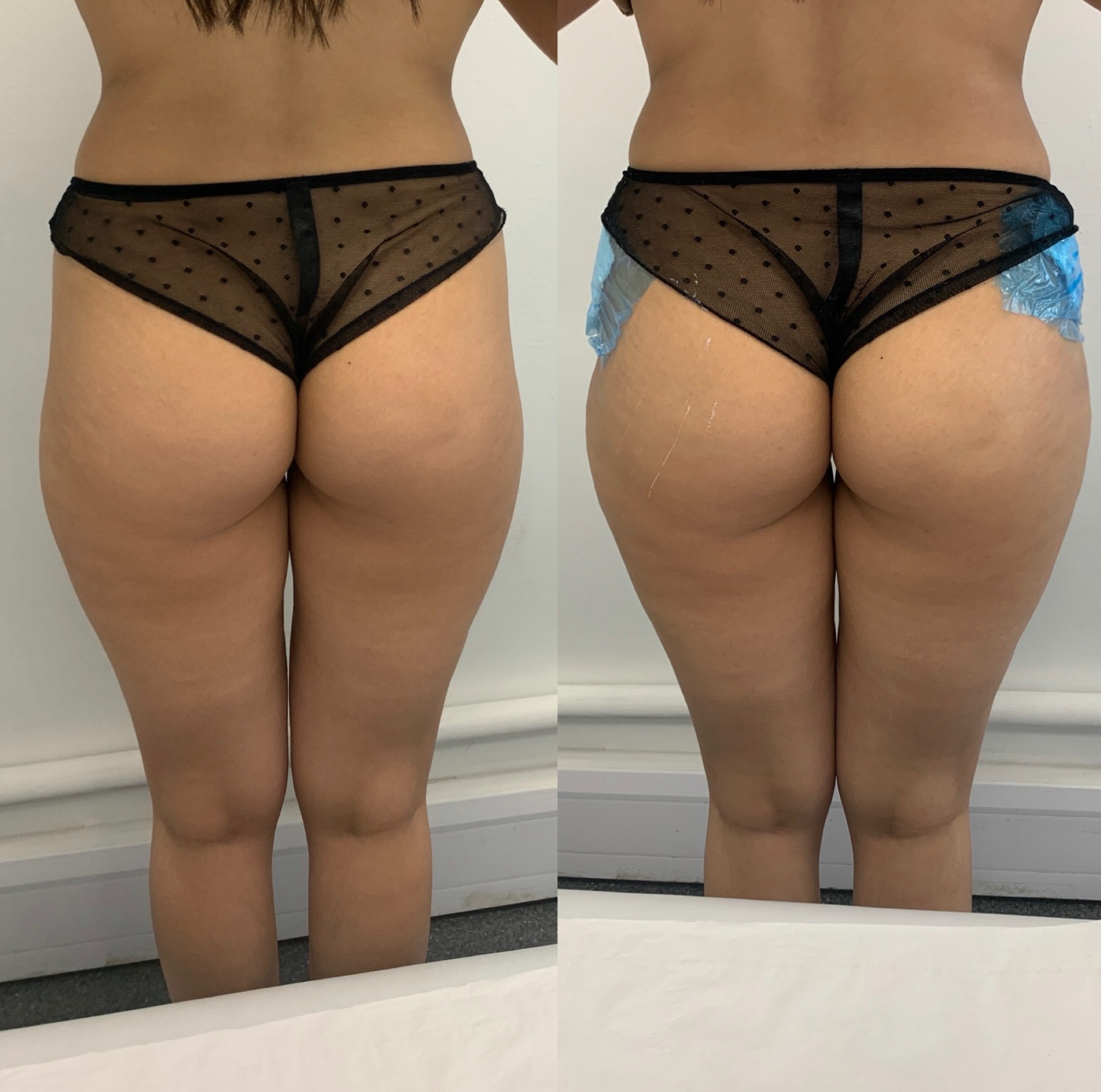 Buttock Augmentation