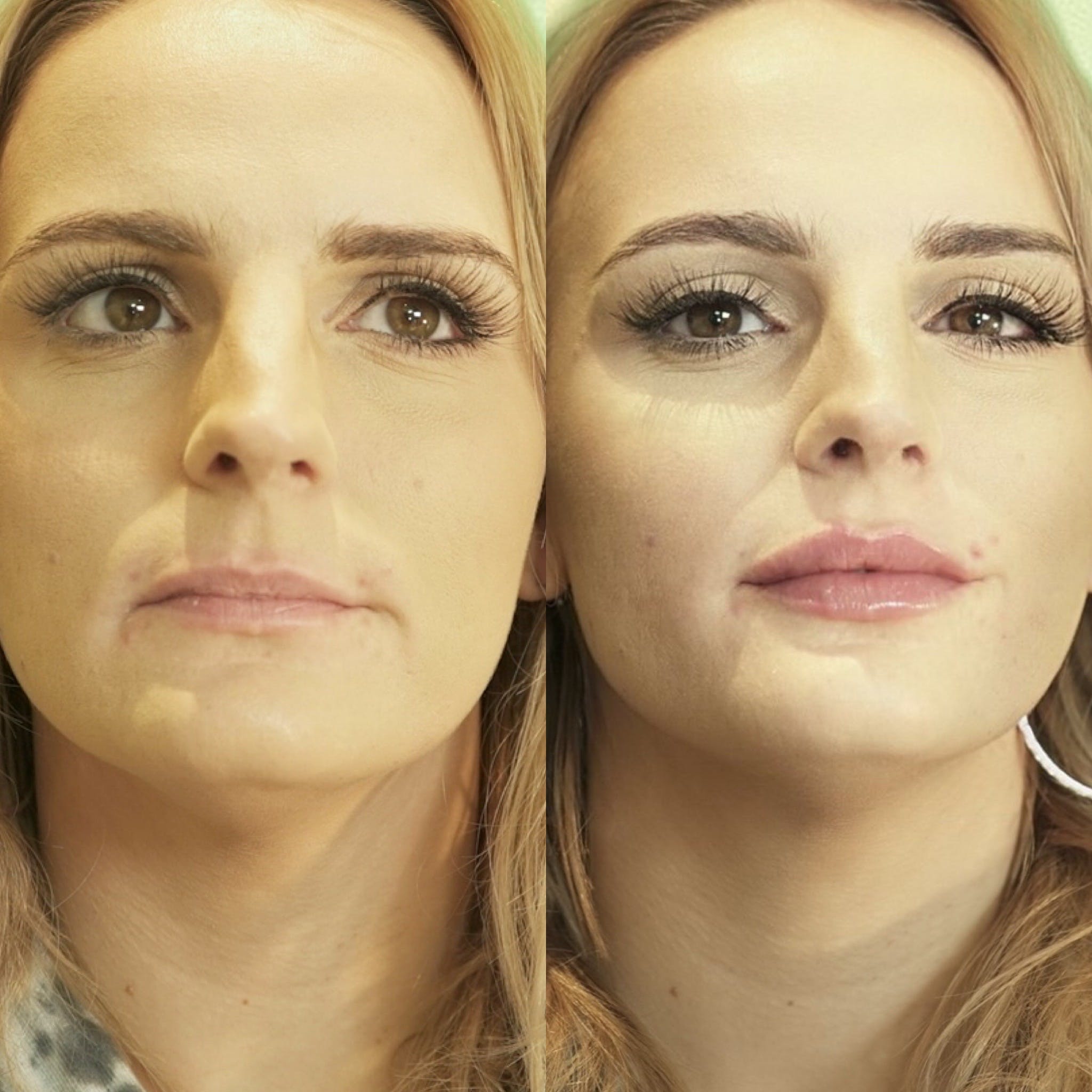 Foundation Lip Augmentation Course