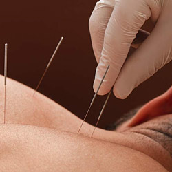 Dry Needling CPD Course 