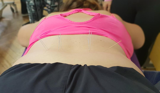 Foundation Dry Needling Course