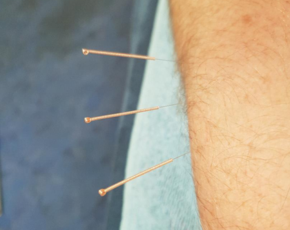 Foundation Dry Needling Course (London, England) Sept 2025