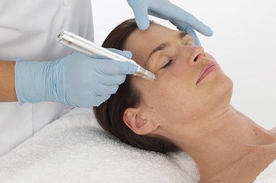 Level 4 Skin Needling