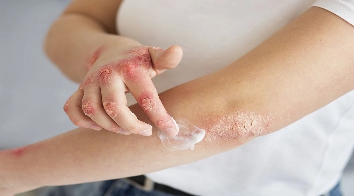 Eczema Solution Course Online