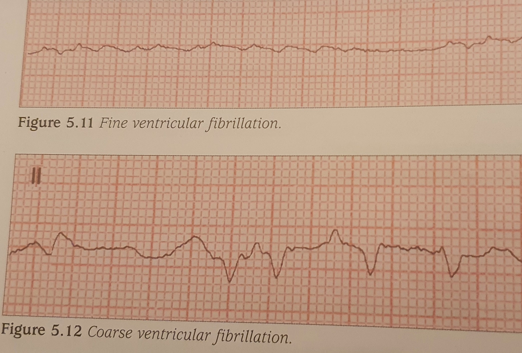 Basic ECG Interpretation