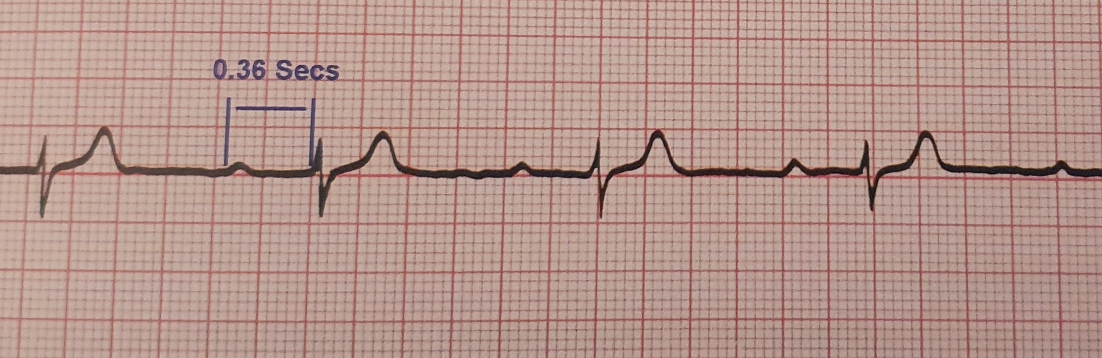 Basic ECG Interpretation