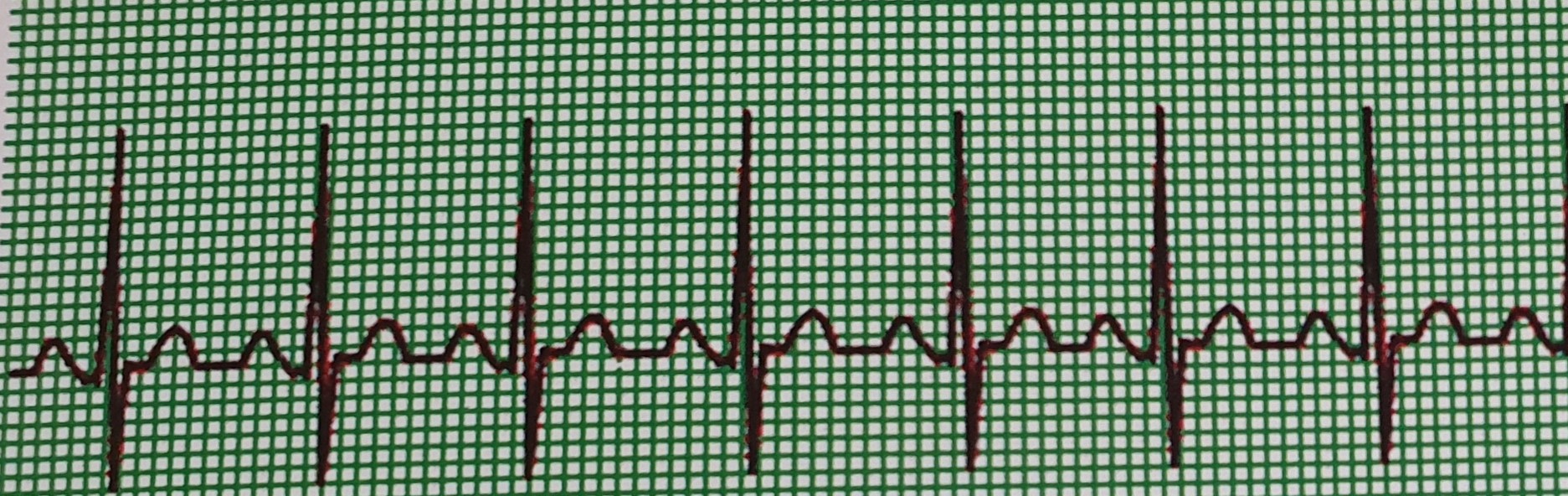 Basic ECG Interpretation