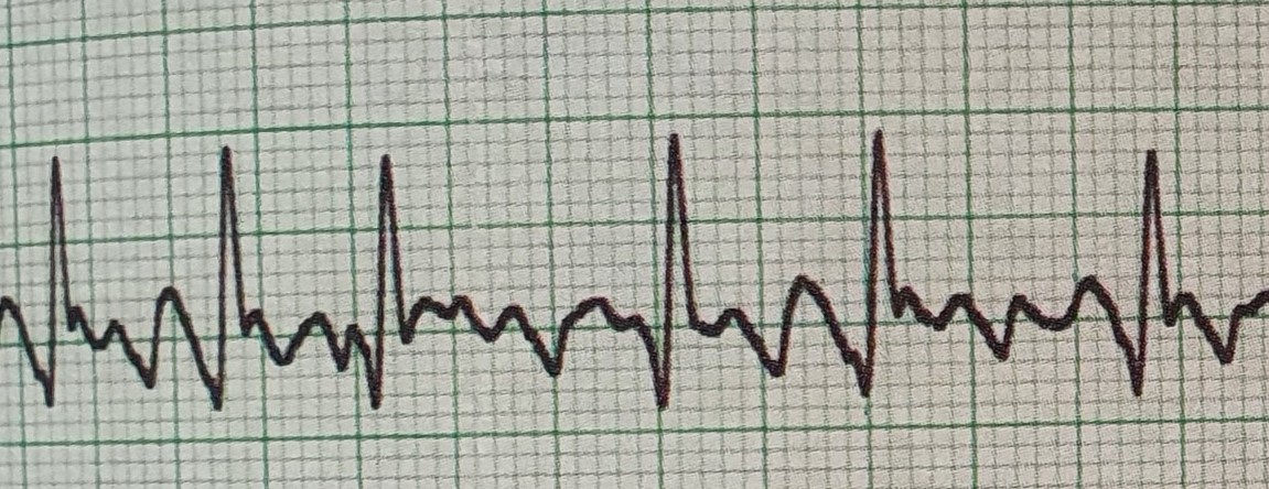 Basic ECG Interpretation